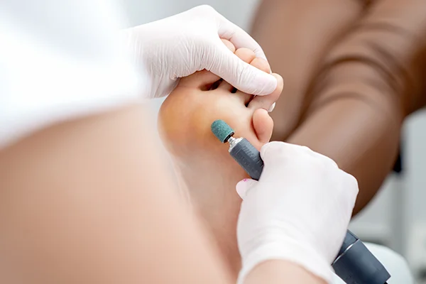 Deep callus removal therapy