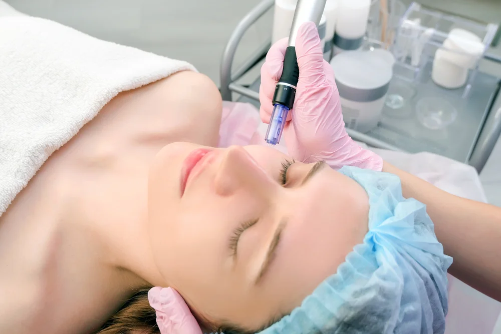 Vivace Microneedling: Types, Benefits, and How It Enhances Your Skin 1 Vivace Microneeling 01