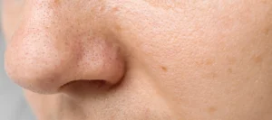 acne pimples on the nose close up - How Can You Clean Clogged Pores From Sunscreen and Sweat?