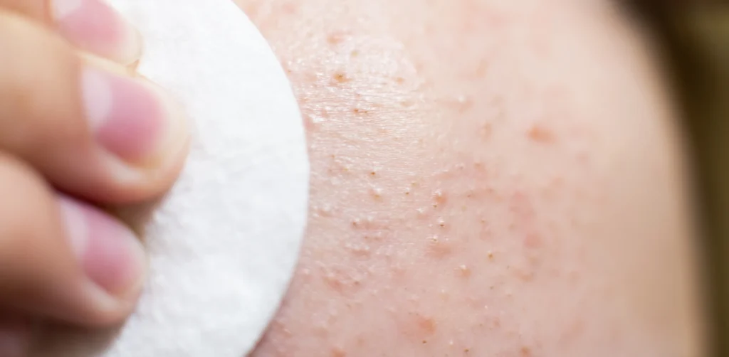 extreme close up of cotton pad wiping skin with acne - How Can You Clean Clogged Pores From Sunscreen and Sweat?