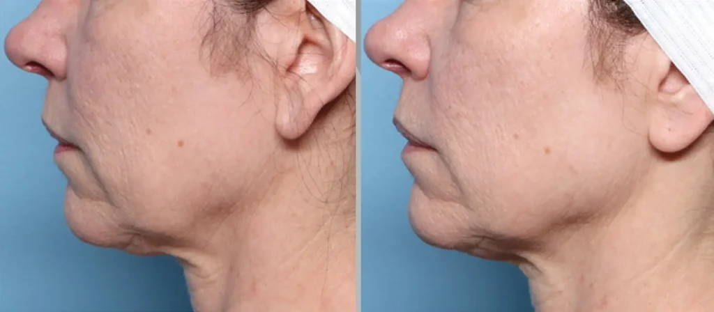 xerf before after
