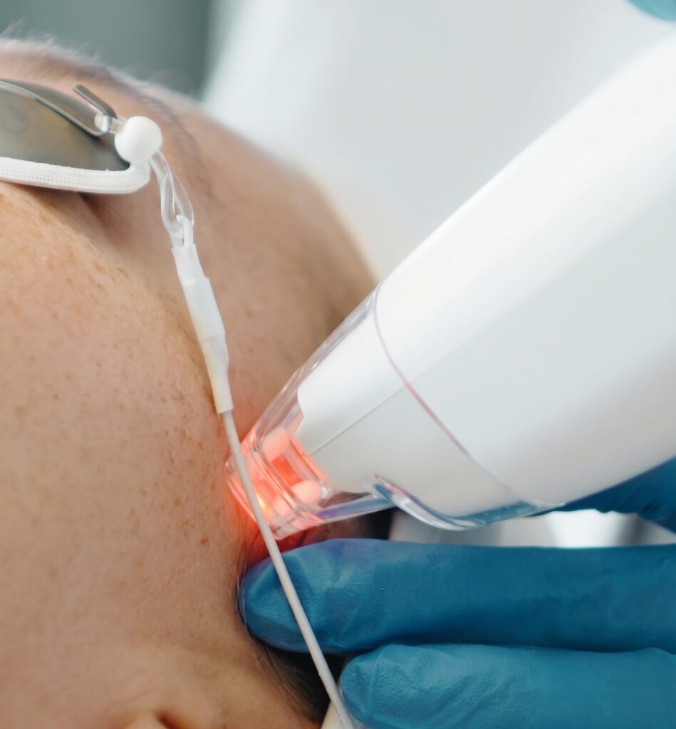What Is the Difference Between Ultra MD Non-Ablative Laser and Traditional Chemical Peels?