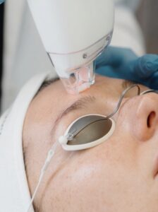 What Is the Difference Between Ultra MD Non-Ablative Laser and Traditional Chemical Peels?