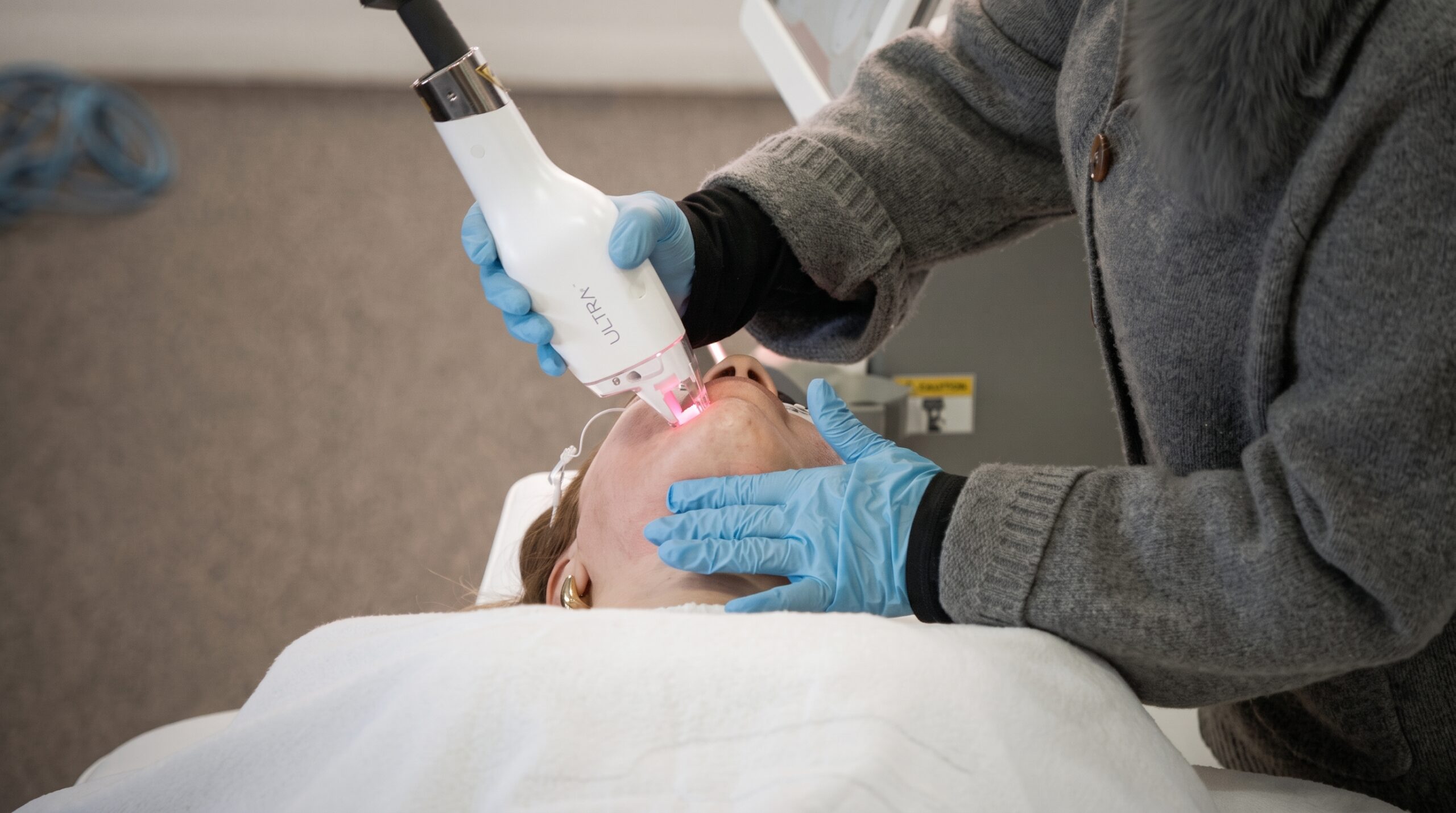 What Are the Real Benefits of LaseMD ULTRA Resurfacing for Sun-Damaged Skin?